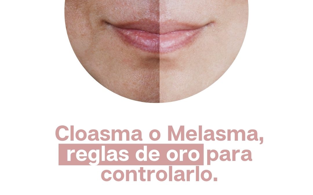 ¿Cleosma o melasma? Reglas de oro